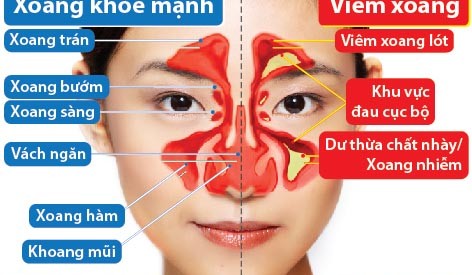 cơ chế bệnh sinh của viêm xoang
