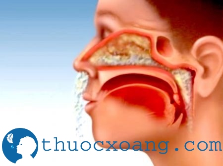 nguyen nhan gay viem xoang