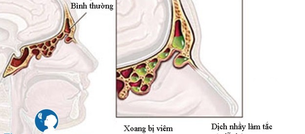 Nguyên nhân dẫn đến viêm xoang